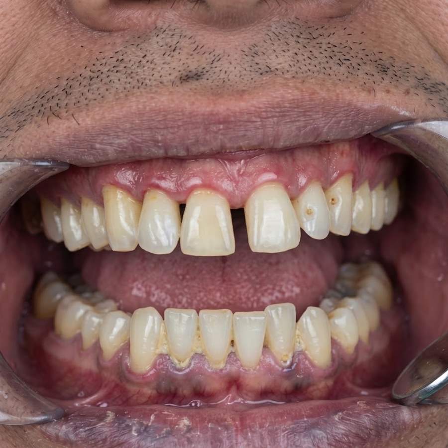 Dry Mouth & Gum Disease
